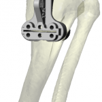 Guide d'ostéotomie mis en place sur une reconstruction 3D de l'os du patient